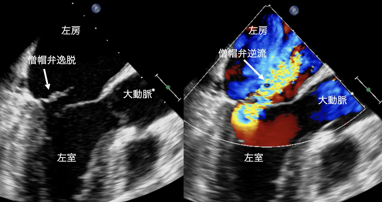 僧帽弁逆流の経食道心エコー図