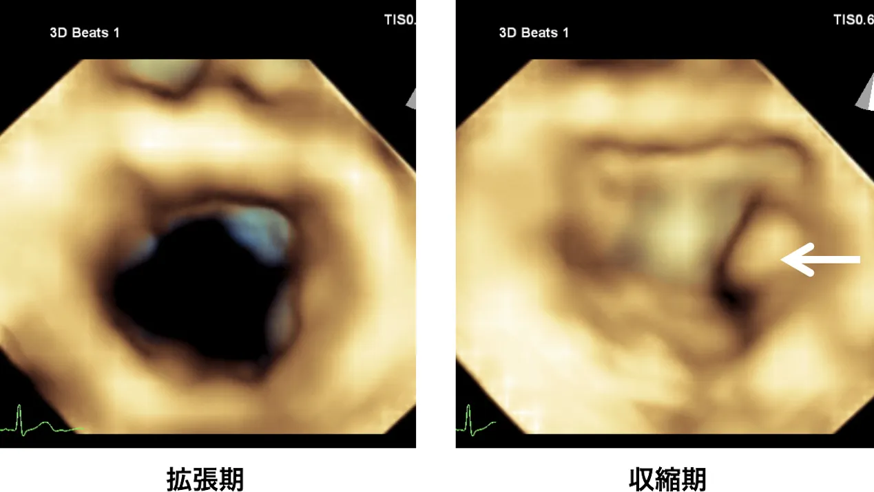 僧帽弁逆流の3D心エコー図