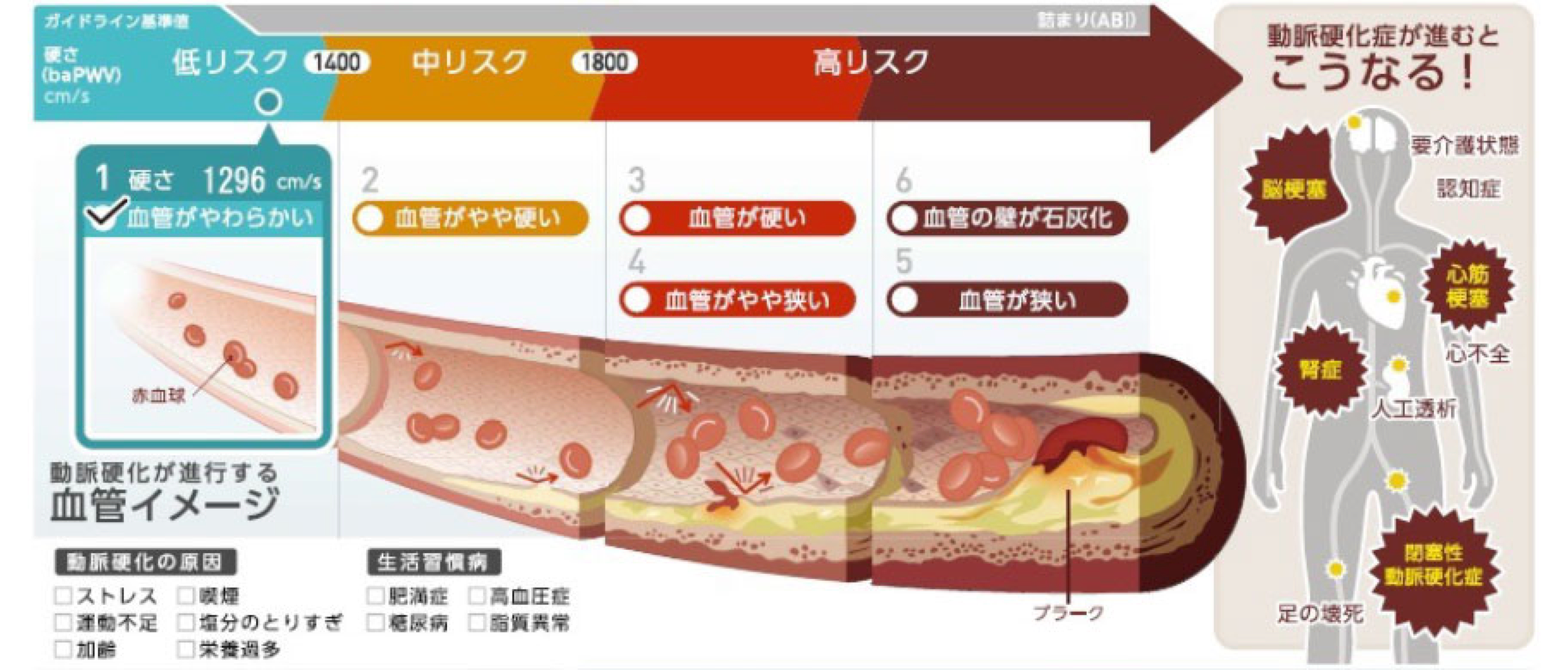 動脈硬化検査（PWV/ABI検査）