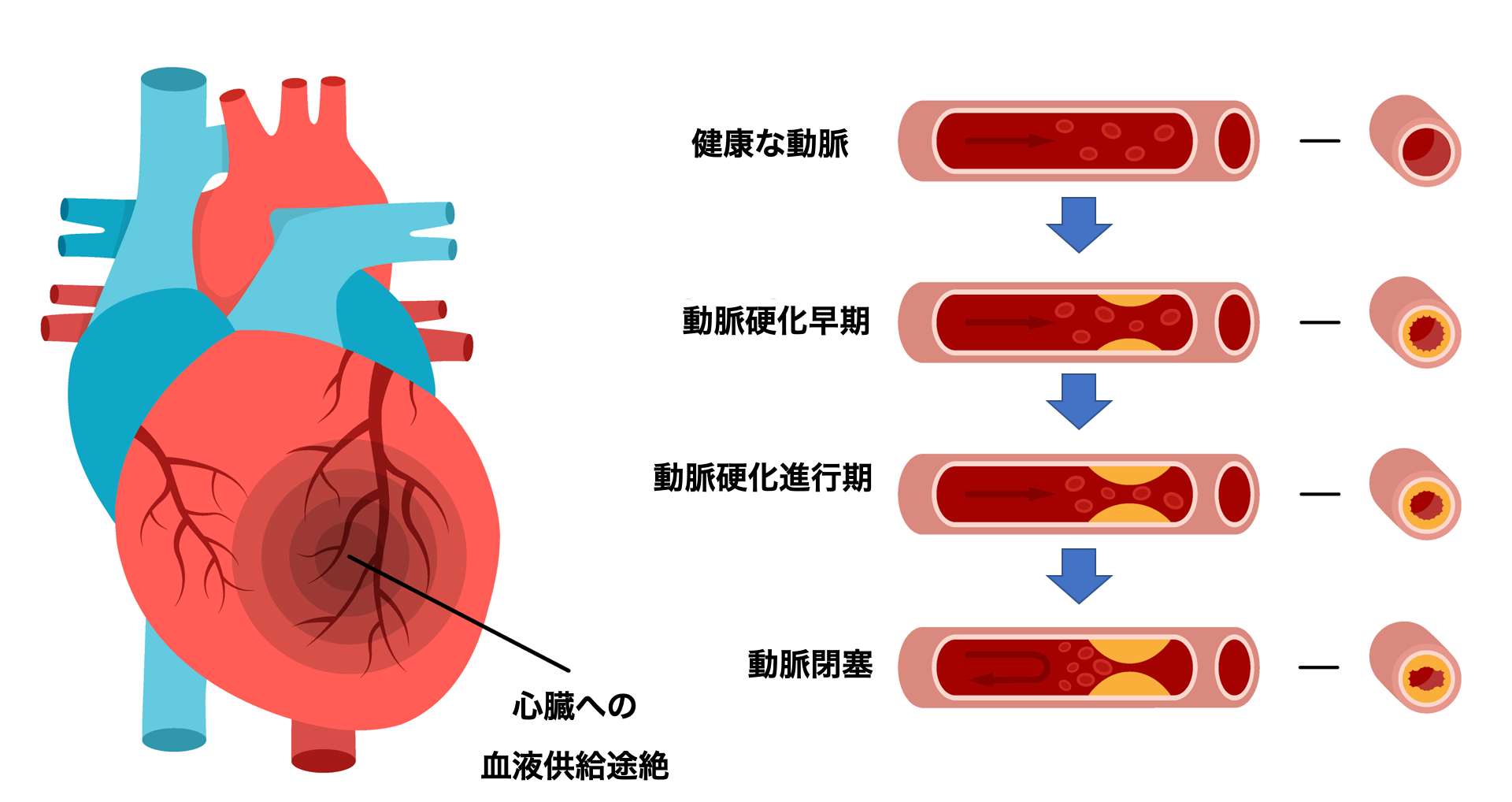 脂質異常症を放置しておくと