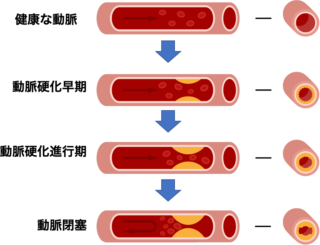 動脈硬化とは