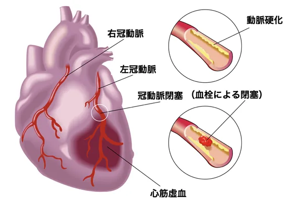 動脈硬化がなくても、冠動脈が痙攣（冠攣縮）すると、心筋に必要な血流が送れなくなり、胸部症状がみられます（冠攣縮性狭心症）。このタイプでは、安静時でも胸部症状がみられます。