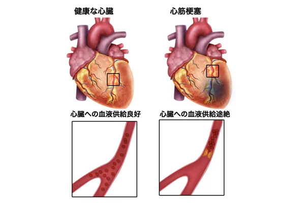 心筋梗塞