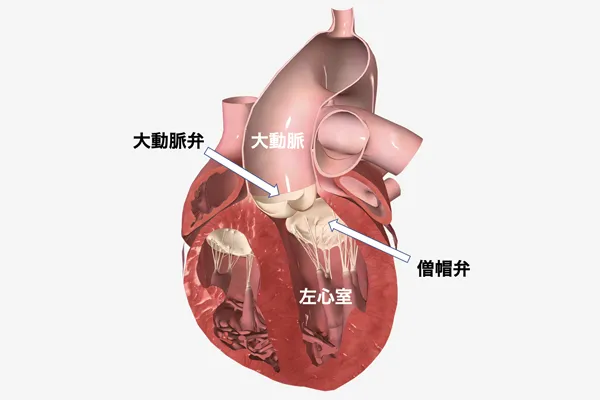 心臓弁膜症