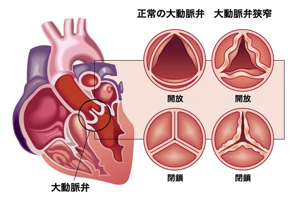 大動脈弁狭窄症