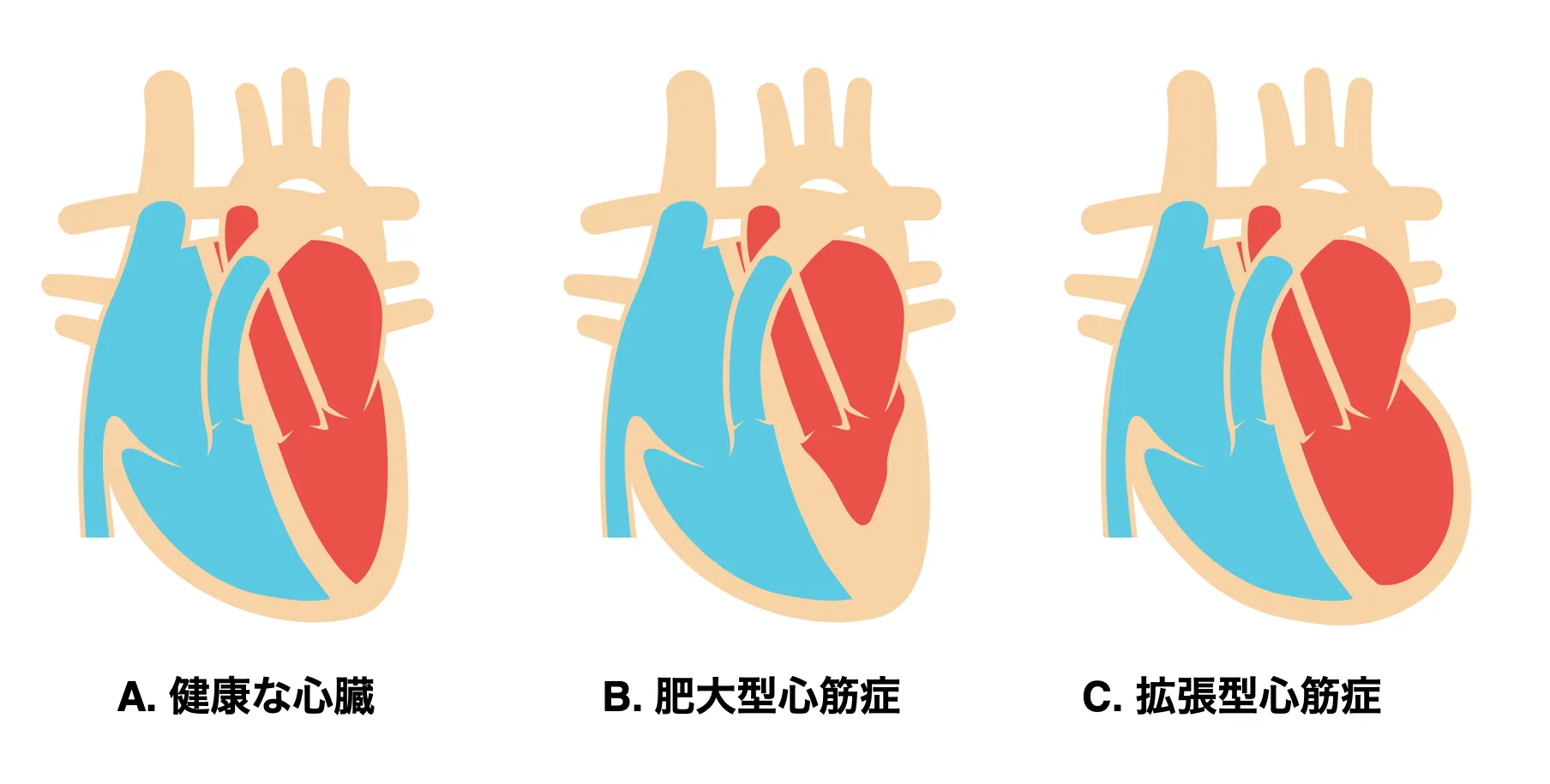 心筋症