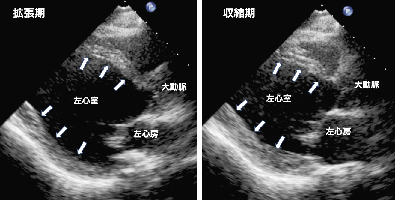 拡張型心筋症