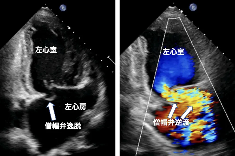 僧帽弁逆流